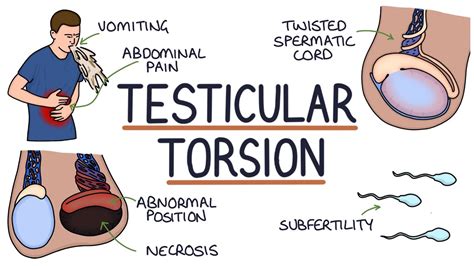 can you get testicular torsion twice|can testicular torsion happen randomly.